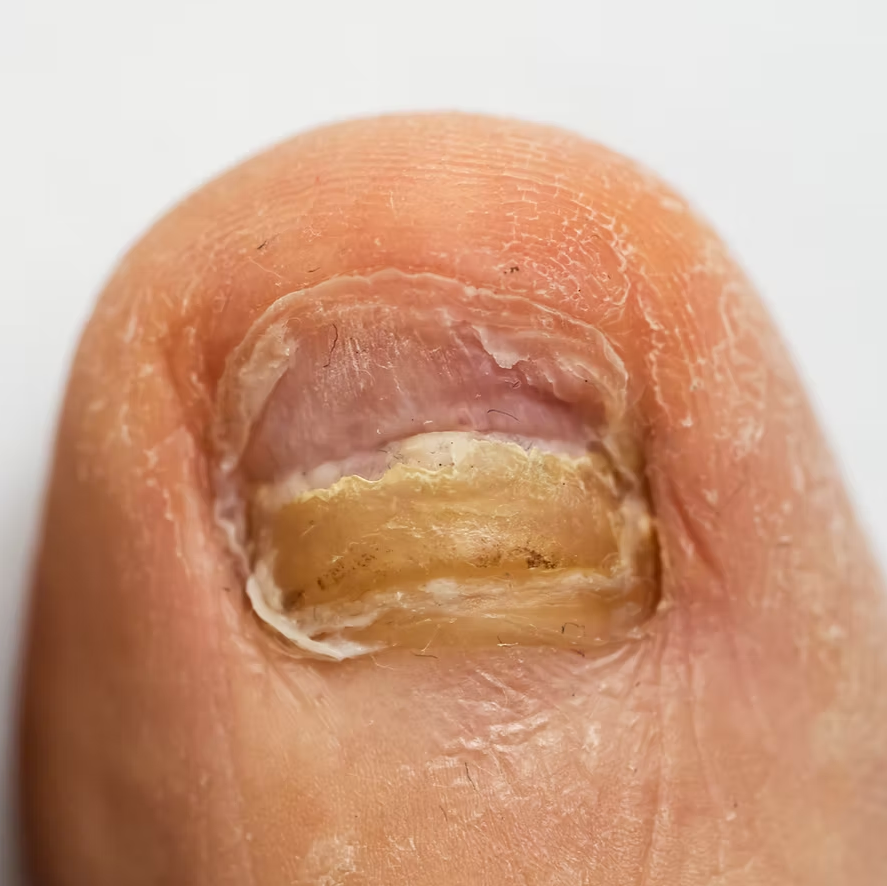 BioMist MD Anti-Fungal Spray for Nail & Feet