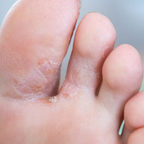 BioMist MD Anti-Fungal Spray for Nail & Feet