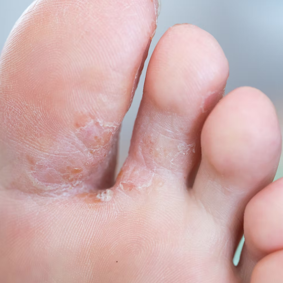 BioMist MD Anti-Fungal Spray for Nail & Feet