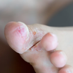 BioMist MD Anti-Fungal Spray for Nail & Feet